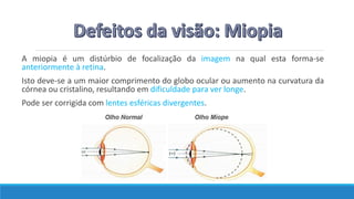 A miopia é um distúrbio de focalização da imagem na qual esta forma-se
anteriormente à retina.
Isto deve-se a um maior comprimento do globo ocular ou aumento na curvatura da
córnea ou cristalino, resultando em dificuldade para ver longe.
Pode ser corrigida com lentes esféricas divergentes.
 