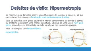 Na hipermetropia também ocorre uma dificuldade de focalizar a imagem, só que
contrariamente à miopia, a focalização se dá posteriormente à retina.
Deve-se portanto a um globo ocular com menor comprimento ou devido à córnea
ou cristalino possuírem uma menor curvatura. Observa-se uma visão ruim para
perto, podendo gerar dificuldade na visão para longe nos casos mais severos.
Pode ser corrigida com lentes esféricas
convergentes.
 