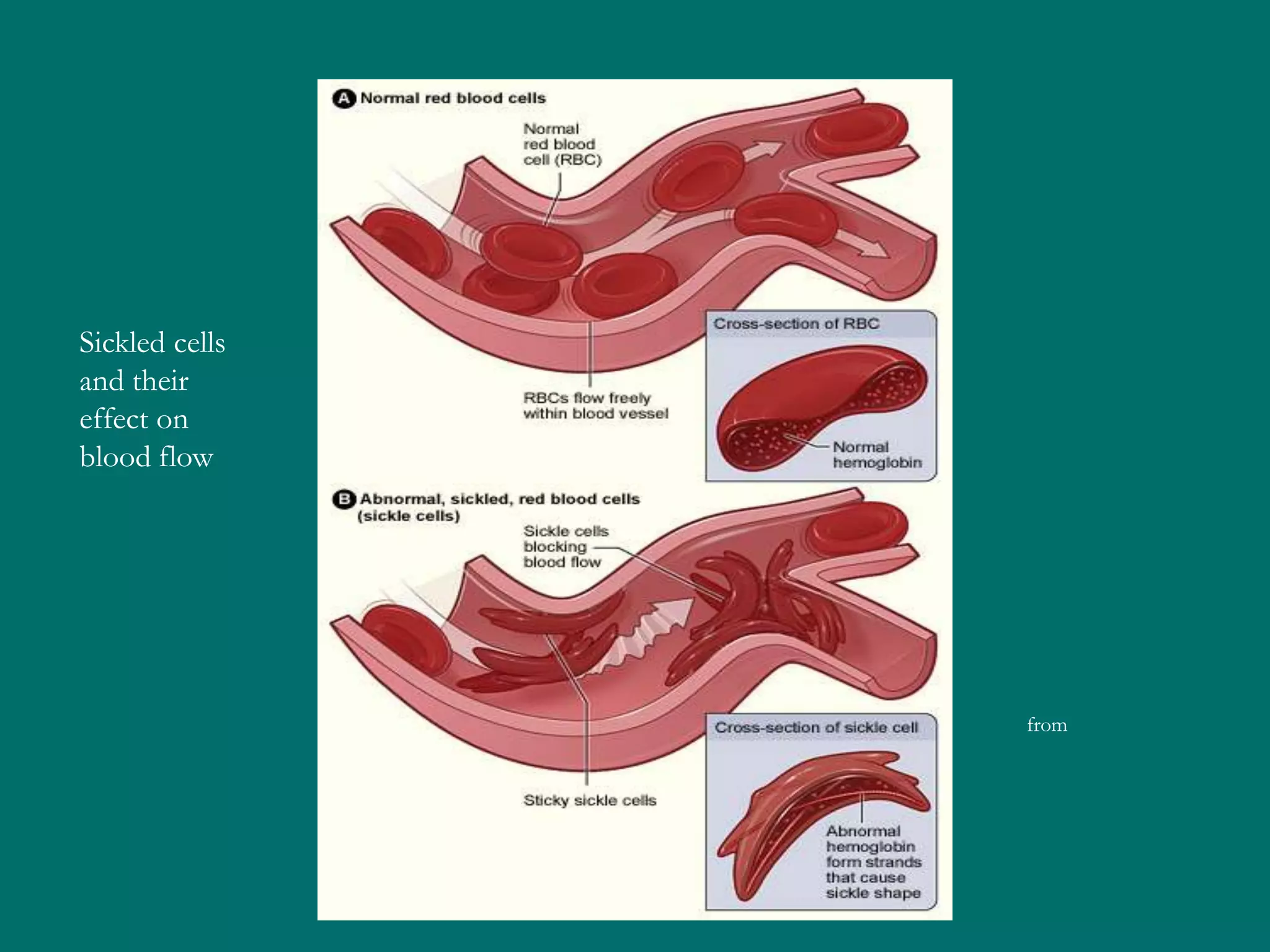 Sickled cells
and their
effect on
blood flow




                from
 