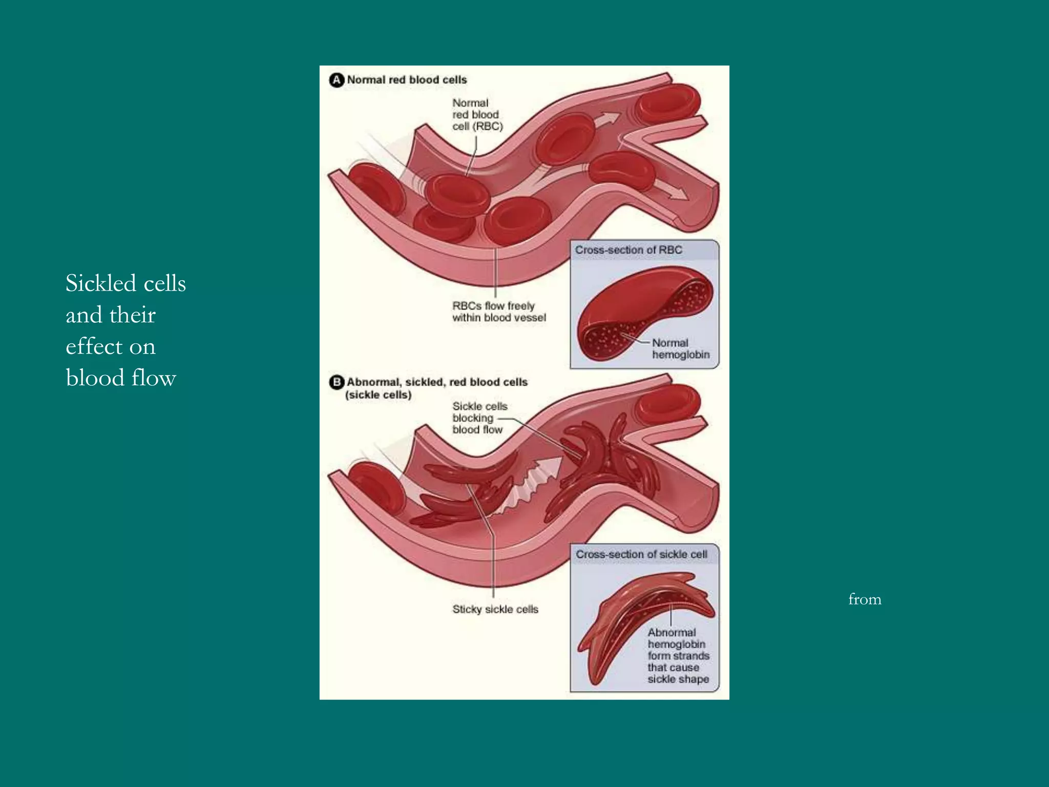 Sickled cells
and their
effect on
blood flow




                from
 