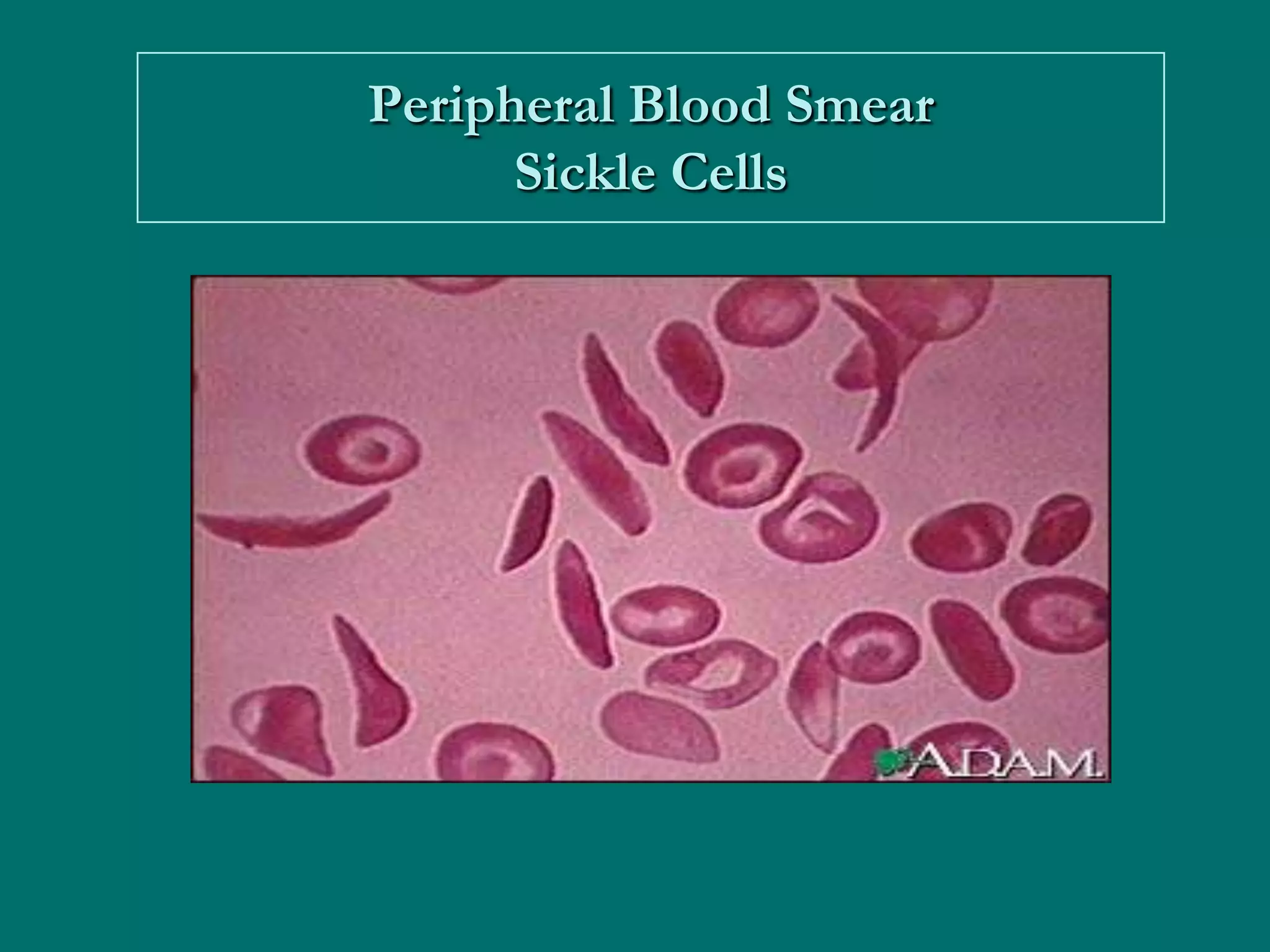 Peripheral Blood Smear
      Sickle Cells
 