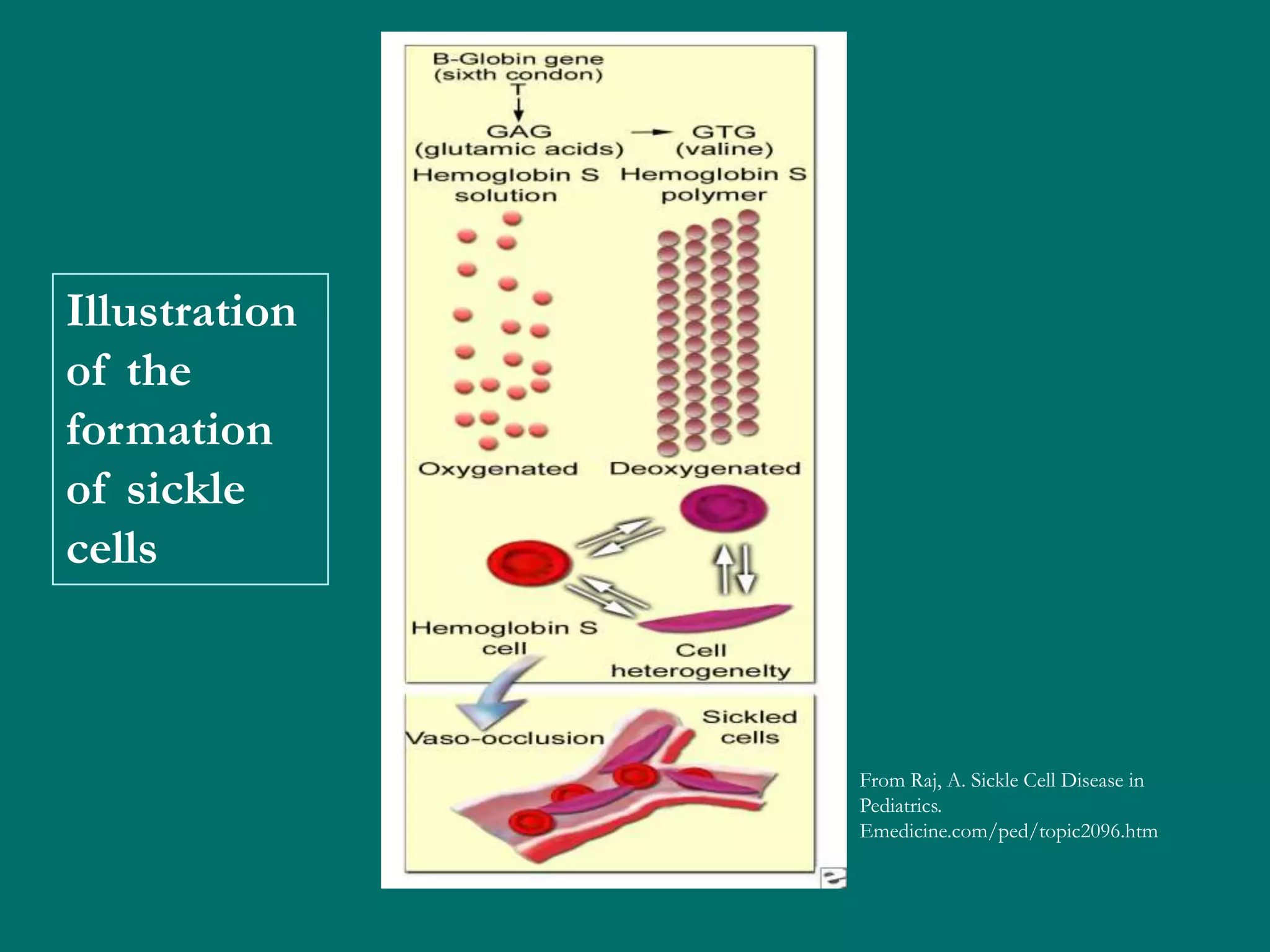 Illustration
of the
formation
of sickle
cells



               From Raj, A. Sickle Cell Disease in
               Pediatrics.
               Emedicine.com/ped/topic2096.htm
 