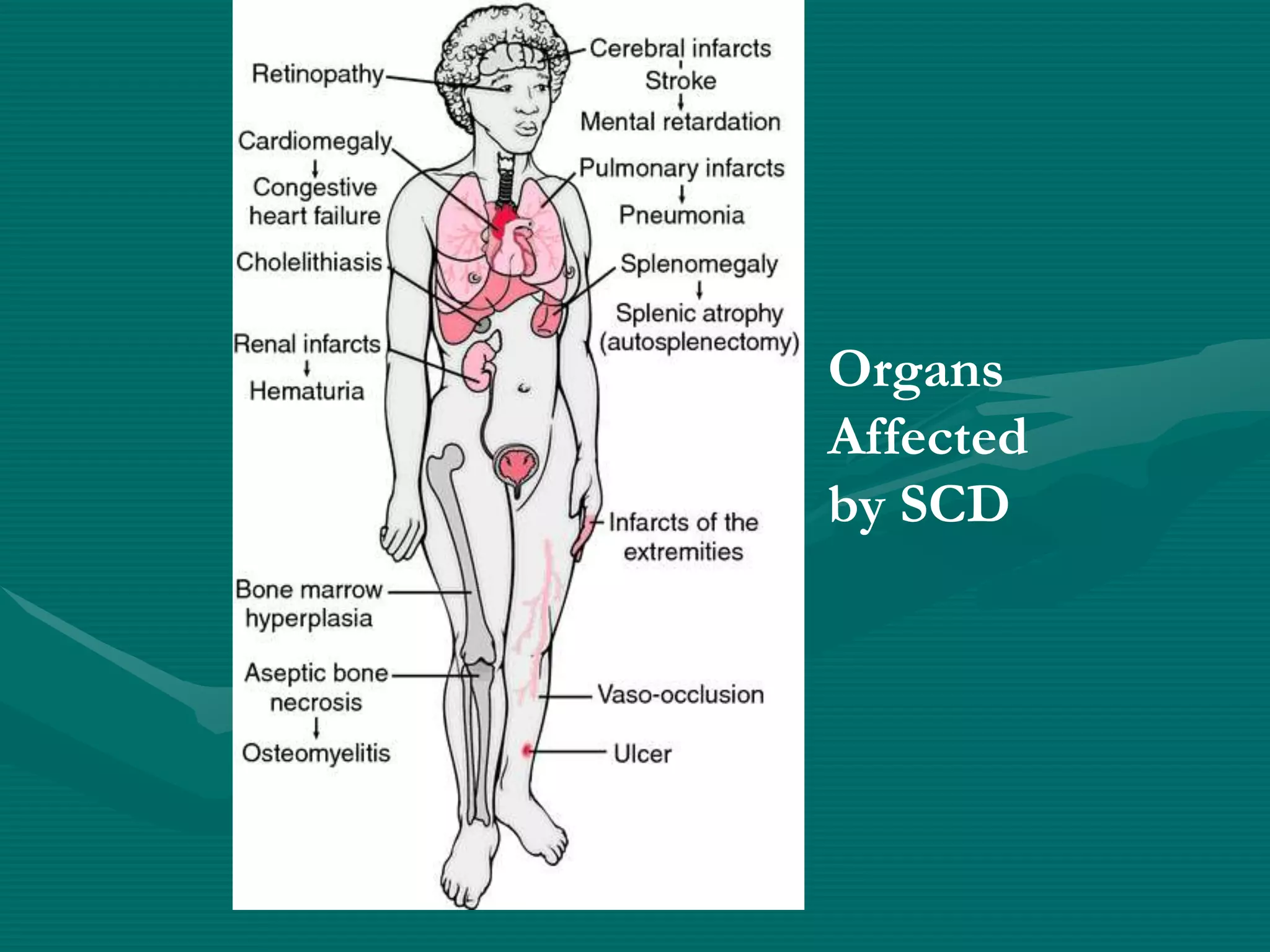 Organs
Affected
by SCD
 