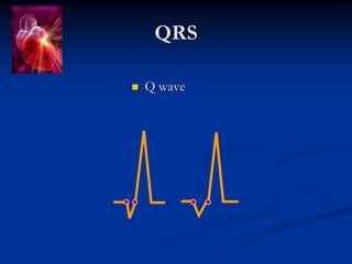 QRS
 Q wave
 