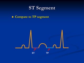 ST Segment
 Compare to TP segment
ST TP
 