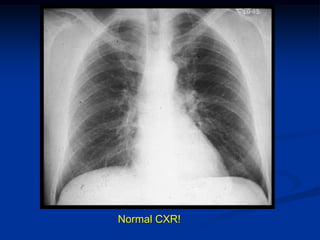 Normal CXR!
 