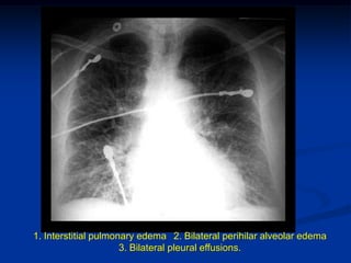 1. Interstitial pulmonary edema 2. Bilateral perihilar alveolar edema
3. Bilateral pleural effusions.
 