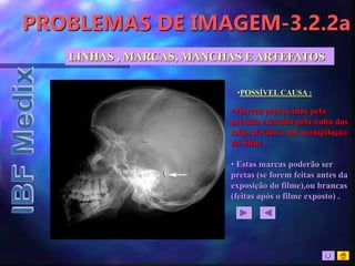 PROBLEMAS DE IMAGEM-3.2.2a
•POSSÍVEL CAUSA :
•Marcas provocadas pela
pressão exercida pela unha das
mãos devido à má manipilação
do filme .
• Estas marcas poderão ser
pretas (se forem feitas antes da
exposição do filme),ou brancas
(feitas após o filme exposto) .
LINHAS , MARCAS, MANCHAS E ARTEFATOS
 