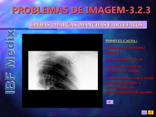 PROBLEMAS DE IMAGEM-3.2.3
LINHAS , MARCAS, MANCHAS E ARTEFATOS
POSSÍVEL CAUSA :
•Descargas eletrostática
devido à :
• Baixa umidade do ar ;
• Fricção de roupa ou
acessórios de Náilon ;
• Atrito do filme com o écran
dos chassis durante o
carregamento ou
descarregamento do mesmo ;
 
