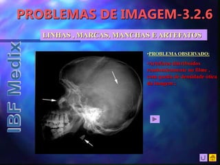 PROBLEMAS DE IMAGEM-3.2.6
LINHAS , MARCAS, MANCHAS E ARTEFATOS
•PROBLEMA OBSERVADO:
•Artefatos distribuídos
randomicamente no filme ,
com queda de densidade ótica
da imagem ;
 