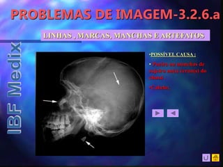 PROBLEMAS DE IMAGEM-3.2.6.a
LINHAS , MARCAS, MANCHAS E ARTEFATOS
•POSSÍVEL CAUSA :
• Poeira ou manchas de
sujeira no(s) écran(s) do
chassi .
•Cabelo;
 