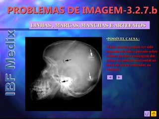 PROBLEMAS DE IMAGEM-3.2.7.b
•Estas marcas podem ter sido
causadas devido à pressão sobre
o filme devido à estocagem das
caixas na posição horizontal ao
invés de serem colocadas na
vertical ;
•POSSÍVEL CAUSA :
LINHAS , MARCAS, MANCHAS E ARTEFATOS
 