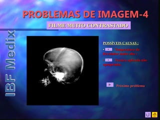 PROBLEMAS DE IMAGEM-4
POSSÍVEIS CAUSAS :
• Temperatura do
Revelador muito alta ;
• Técnica aplicada não
apropriada;
FILME MUITO CONTRASTADO
Próximo problema
 