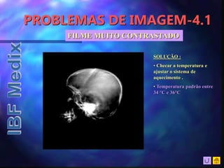 PROBLEMAS DE IMAGEM-4.1
SOLUÇÃO :
• Checar a temperatura e
ajustar o sistema de
aquecimento .
• Temperatura padrão entre
34 °C e 36°C
FILME MUITO CONTRASTADO
 