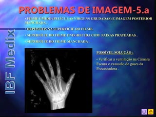 PROBLEMAS DE IMAGEM-5.a
• FILME ÚMIDO (PELÍCULAS VIRGENS GRUDADAS) E IMAGEM POSTERIOR
MANCHADA .
• DEPÓSITOS NA SUPERFÍCIE DO FILME.
• SUPERFÍCIE DO FILME ENEGRECIDA COM FAIXAS PRATEADAS .
• SUPERFÍCIE DO FILME MANCHADA .
POSSÍVEL SOLUÇÃO :
• Verificar a ventilação na Câmara
Escura e exaustão de gases da
Processadora .
 