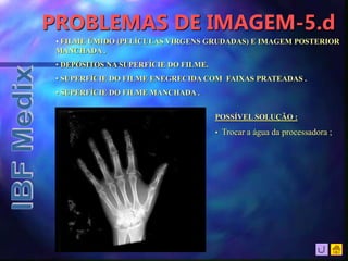 PROBLEMAS DE IMAGEM-5.d
• FILME ÚMIDO (PELÍCULAS VIRGENS GRUDADAS) E IMAGEM POSTERIOR
MANCHADA .
• DEPÓSITOS NA SUPERFÍCIE DO FILME.
• SUPERFÍCIE DO FILME ENEGRECIDA COM FAIXAS PRATEADAS .
• SUPERFÍCIE DO FILME MANCHADA .
POSSÍVEL SOLUÇÃO :
• Trocar a água da processadora ;
 