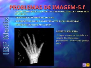 PROBLEMAS DE IMAGEM-5.f
• FILME ÚMIDO (PELÍCULAS VIRGENS GRUDADAS) E IMAGEM POSTERIOR
MANCHADA .
• DEPÓSITOS NA SUPERFÍCIE DO FILME.
• SUPERFÍCIE DO FILME ENEGRECIDA COM FAIXAS PRATEADAS .
• SUPERFÍCIE DO FILME MANCHADA .
POSSÍVEL SOLUÇÃO :
• Limpar o tanque do revelador e o
sistema de circulação da
processadora , recolocando químico
novo ;
 