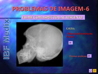 PROBLEMAS DE IMAGEM-6
FILME COM ASPECTO LACTESCENTE
CAUSA :
• Filme insuficientemente
Fixado;
Próximo problema
 