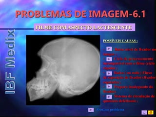 PROBLEMAS DE IMAGEM-6.1
FILME COM ASPECTO LACTESCENTE
POSSÍVEIS CAUSAS :
• Baixo nível de fixador no
tanque ;
• Ciclo de processamento
incompatível com o filme (ciclo
rápido) ;
• Baixo ( ou nulo ) Fluxo
de reposição de fixador (fixador
esgotado) ;
• Preparo inadequado do
fixador;
• Sistema de circulação de
químicos defeituoso ;
Próximo problema
 