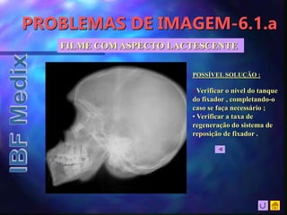 PROBLEMAS DE IMAGEM-6.1.a
FILME COM ASPECTO LACTESCENTE
POSSÍVEL SOLUÇÃO :
• Verificar o nível do tanque
do fixador , completando-o
caso se faça necessário ;
• Verificar a taxa de
regeneração do sistema de
reposição de fixador .
 