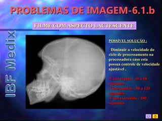 PROBLEMAS DE IMAGEM-6.1.b
FILME COM ASPECTO LACTESCENTE
POSSÍVEL SOLUÇÃO :
• Diminuir a velocidade do
ciclo de processamento na
processadora caso esta
possua controle de velocidade
ajustável .
•Ciclo rápido : 45 a 60
segundos .
•Ciclo padrão : 90 a 120
segundos .
•Ciclo extendido : 180
segundos .
 