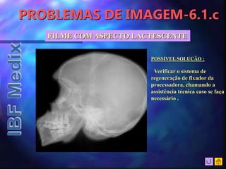 PROBLEMAS DE IMAGEM-6.1.c
FILME COM ASPECTO LACTESCENTE
POSSÍVEL SOLUÇÃO :
• Verificar o sistema de
regeneração de fixador da
processadora, chamando a
assistência técnica caso se faça
necessário .
 