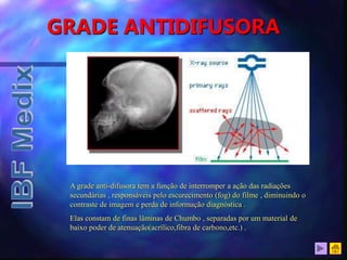 GRADE ANTIDIFUSORA
A grade anti-difusora tem a função de interromper a ação das radiações
secundárias , responsáveis pelo escurecimento (fog) do filme , diminuindo o
contraste de imagem e perda de informação diagnóstica .
Elas constam de finas lâminas de Chumbo , separadas por um material de
baixo poder de atenuação(acrílico,fibra de carbono,etc.) .
 