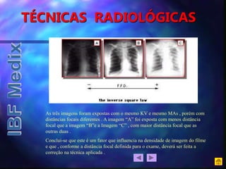 TÉCNICAS RADIOLÓGICAS
As três imagens foram expostas com o mesmo KV e mesmo MAs , porém com
distâncias focais diferentes . A imagem “A” foi exposta com menos distância
focal que a imagem “B”e a Imagem “C” , com maior distância focal que as
outras duas .
Conclui-se que este é um fator que influencia na densidade de imagem do filme
e que , conforme a distância focal definida para o exame, deverá ser feita a
correção na técnica aplicada .
 