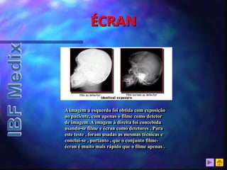 ÉCRAN
A imagem à esquerda foi obtida com exposição
ao paciente, com apenas o filme como detetor
de imagem. A imagem à direita foi concebida
usando-se filme e écran como detetores . Para
este teste , foram usadas as mesmas técnicas e
conclui-se , portanto , que o conjunto filme-
écran é muito mais rápido que o filme apenas .
 