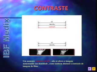 CONTRASTE
Um aumento excessivo de KV , não só altera a imagem
aumentando sua densidade , como também diminui o contraste de
imagem do filme .
 
