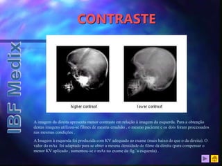CONTRASTE
A imagem da direita apresenta menor contraste em relação à imagem da esquerda. Para a obtenção
destas imagens utilizou-se filmes de mesma emulsão , o mesmo paciente e os dois foram processados
nas mesmas condições .
A Imagem à esquerda foi produzida com KV adequado ao exame (mais baixo do que o da direita). O
valor do mAs foi adaptado para se obter a mesma densidade do filme da direita (para compensar o
menor KV aplicado , aumentou-se o mAs no exame da fig.`a esquerda) .
 