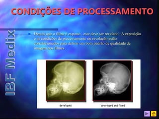 CONDIÇÕES DE PROCESSAMENTO
 Depois que o filme é exposto , este deve ser revelado . A exposição
e as condições de processamento ou revelação estão
correlacionados para definir um bom padrão de qualidade de
imagem nos filmes .
 