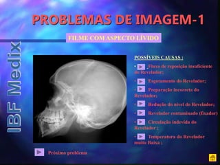 PROBLEMAS DE IMAGEM-1
FILME COM ASPECTO LÍVIDO
POSSÍVEIS CAUSAS :
• Fluxo de reposição insuficiente
do Revelador;
• Esgotamento do Revelador;
• Preparação incorreta do
Revelador;
• Redução do nível do Revelador;
• Revelador contaminado (fixador)
• Circulação indevida do
Revelador ;
• Temperatura do Revelador
muito Baixa ;
Próximo problema
 