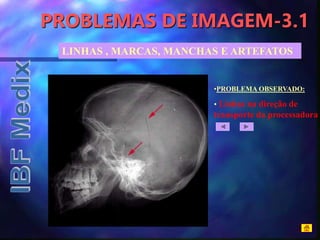 PROBLEMAS DE IMAGEM-3.1
•PROBLEMA OBSERVADO:
• Linhas na direção de
transporte da processadora
LINHAS , MARCAS, MANCHAS E ARTEFATOS
 