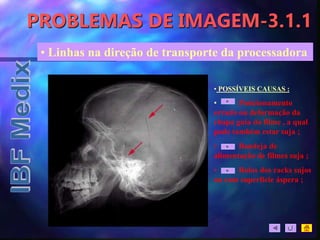 PROBLEMAS DE IMAGEM-3.1.1
• Linhas na direção de transporte da processadora
• POSSÍVEIS CAUSAS :
• Posicionamento
errado ou deformação da
chapa guia do filme , a qual
pode também estar suja ;
• Bandeja de
alimentação de filmes suja ;
• Rolos dos racks sujos
ou com superfície áspera ;
 