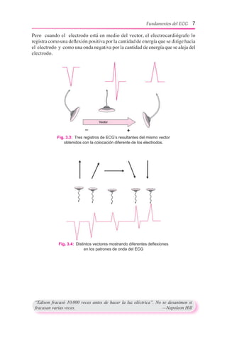Pero cuando el electrodo está en medio del vector, el electrocardiógrafo lo
registra como una deflexión positiva por la cantidad de energía que se dirige hacia
el electrodo y como una onda negativa por la cantidad de energía que se aleja del
electrodo.
Fig. 3.3:  Tres registros de ECG’s resultantes del mismo vector
obtenidos con la colocación diferente de los electrodos.
Fig. 3.4:  Distintos vectores mostrando diferentes deflexiones
en los patrones de onda del ECG
“Edison fracasó 10,000 veces antes de hacer la luz eléctrica”. No se desanimen si
fracasan varias veces.	 —Napoleon Hill
Fundamentos del ECG 7
 