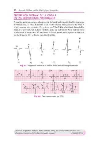 16  Aprenda ECG en un Día: Un Enfoque Sistemático
PROGRESIÓN NORMAL DE LA ONDA R
EN LAS DERIVACIONES PRECORDIALES
A medida que avanzamos en la dirección del ventrículo izquierdo eléctricamente
predominante, la onda R tiende a ser relativamente más grande y la onda R
relativamente más pequeña. En general, en V3 o V4 la relación de la onda R a
onda S se convierte en 1. Esto se llama zona de transición. Si la transición se
produce tan pronto como V2, entonces se llama transición temprana y si ocurre
tan tarde como V5, se llama transición tardía.
Fig. 6.7:  Progresión normal de la onda R en las derivaciones precordiales
Fig. 6.8:  Patrones normales del ECG
“Cuando aceptamos trabajos duros como un reto y nos involucramos en ellos con
alegría y entusiasmo, los milagros pueden suceder.”	 —Arland Gilbert
 