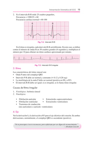 Interpretación Sistemática del ECG 19
2.	 Si el intervalo R-R mide 25 cuadros pequeños,
	 Frecuencia = 1500/25 = 60
	 Frecuencia cardiaca normal = 60-100
Fig. 7.4:  Intervalo R-Rl
	 Si el ritmo es irregular, cada intervalo R-R será diferente. En este caso, se deben
contar el número de ondas R en 30 cuadros grandes (6 segundos) y multiplicar el
número por 10 para obtener un ritmo cardíaco aproximado por minuto.
Fig. 7.5:  Intervalo R-R irregular
3. Ritmo
Las características del ritmo sinusal son:
•	 Onda P antes del complejo QRS
•	 Intervalo P-R debe ser normal y constante (÷ 0.12 y 0.20 seg)
•	 La morfología de la onda P debe ser normal (positiva en DI y aVF)
•	 El intervalo R-R debe ser igual; si es irregular, se le llama ritmo irregular.
Causas de Ritmo Irregular
1.	 Fisiológica: Arritmia sinusal
2.	 Patológica:
	 •	 Fibrilación aurícular	 •     Estrasístoles supraventrículares
	 •	 Fibrilación ventrícular	 •     Extrasístoles ventrículares
	 •	 Trastornos de conducción
           sino-aurículares o aurículo -ventrículares
4. Eje
Ver la derivación I y la derivación aVF para el eje eléctrico del corazón. En ambas
derivaciones, normalmente, el complejo QRS es ascendente (positivo).
“No te preocupes si no te reconocen, pero esfuérzate por ser digno de reconocimiento.”
	 —Abraham Lincoln
 