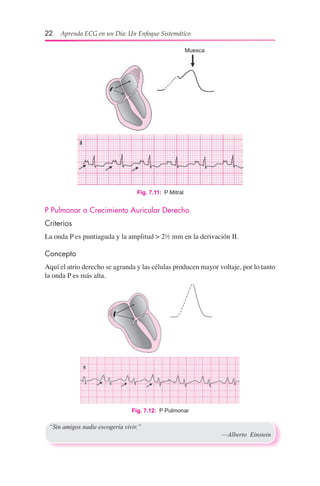22  Aprenda ECG en un Día: Un Enfoque Sistemático
P Pulmonar o Crecimiento Auricular Derecho
Criterios
La onda P es puntiaguda y la amplitud > 2½ mm en la derivación II.
Concepto
Aquí el atrio derecho se agranda y las células producen mayor voltaje, por lo tanto
la onda P es más alta.
Fig. 7.11:  P Mitral
Fig. 7.12:  P Pulmonar
“Sin amigos nadie escogería vivir.”
	 —Alberto Einstein
Muesca
 