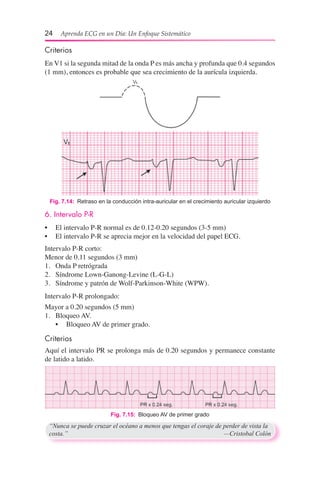 24  Aprenda ECG en un Día: Un Enfoque Sistemático
Fig. 7.14:  Retraso en la conducción intra-auricular en el crecimiento auricular izquierdo
6. Intervalo P-R
•	 El intervalo P-R normal es de 0.12-0.20 segundos (3-5 mm)
•	 El intervalo P-R se aprecia mejor en la velocidad del papel ECG.
Intervalo P-R corto:
Menor de 0.11 segundos (3 mm)
1.	 Onda P retrógrada
2.	 Síndrome Lown-Ganong-Levine (L-G-L)
3.	 Síndrome y patrón de Wolf-Parkinson-White (WPW).
Intervalo P-R prolongado:
Mayor a 0.20 segundos (5 mm)
1.	 Bloqueo AV.
	 •	 Bloqueo AV de primer grado.
Criterios
Aquí el intervalo PR se prolonga más de 0.20 segundos y permanece constante
de latido a latido.
Fig. 7.15:  Bloqueo AV de primer grado
Criterios
En V1 si la segunda mitad de la onda P es más ancha y profunda que 0.4 segundos
(1 mm), entonces es probable que sea crecimiento de la aurícula izquierda.
“Nunca se puede cruzar el océano a menos que tengas el coraje de perder de vista la
costa.”	 —Cristobal Colón
 