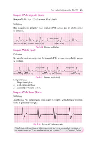 Interpretación Sistemática del ECG 25
Fig. 7.17:  Bloqueo Mobitz tipo II
Bloqueo AV de Segundo Grado
Bloqueo Mobitz tipo I (Fenómeno de Wenckebach)
Criterios
Hay alargamiento progresivo del intervalo P-R seguido por un latido que no
se conduce.
Fig. 7.16:  Bloqueo Mobitz tipo I
Bloqueo Mobitz Tipo II
Criterios
No hay alargamiento progresivo del intervalo P-R, seguido por un latido que no
se conduce.
Complicaciones
1.	 Bloqueo completo
2.	 Insuficiencia cardiaca
3.	 Síndrome de Adams-Stokes.
Bloqueo AV de Tercer Grado
Criterios
Aquí la onda P no tiene ninguna relación con el complejo QRS. Siempre tiene más
ondas P que complejos QRS.
Fig. 7.18:  Bloqueo AV de tercer grado
“Muchos de los fracasos de la vida son personas que no se habían dado cuenta de lo
cerca que estaban del éxito cuando se dieron por vencidos.”	 —Thomas A Edison
 