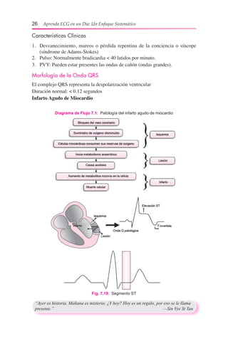 26  Aprenda ECG en un Día: Un Enfoque Sistemático
Características Clínicas
1.	 Desvanecimiento, mareos o pérdida repentina de la conciencia o síncope
(síndrome de Adams-Stokes)
2.	 Pulso: Normalmente bradicardia < 40 latidos por minuto.
3.	 PVY: Pueden estar presentes las ondas de cañón (ondas grandes).
Morfología de la Onda QRS
El complejo QRS representa la despolarización ventricular
Duración normal: < 0.12 segundos
Infarto Agudo de Miocardio
Fig. 7.19:  Segmento ST
Diagrama de Flujo 7.1:  Patología del infarto agudo de miocardio
“Ayer es historia. Mañana es misterio. ¿Y hoy? Hoy es un regalo, por eso se le llama
presente.”	 —Sin Vye St Tan
 
