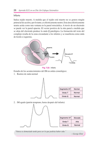 28  Aprenda ECG en un Día: Un Enfoque Sistemático
Infarto
Indica tejido muerto. A medida que el tejido está muerto no se genera ningún
potencial de acción y por lo tanto, es eléctricamente neutro. Esta área eléctricamente
neutra actúa como una ventana en la pared miocárdica. A través de un electrodo
se puede ver la pared opuesta. El vector positivo de la otra pared a medida que
se aleja del electrodo produce la onda Q patológica. La formación del resto del
complejo resulta de la zona circundante a los infartos y se manifiesta como onda
de lesión o isquemia.
Estudio de los acontecimientos del IM en orden cronológico:
1.	 Rastreo de onda normal
2.	 IM agudo (patrón temprano, horas después del infarto)
Fig. 7.22:  Infarto
“Nunca es demasiado tarde para ser lo que podrías haber sido.”
	 —George Eliot
 