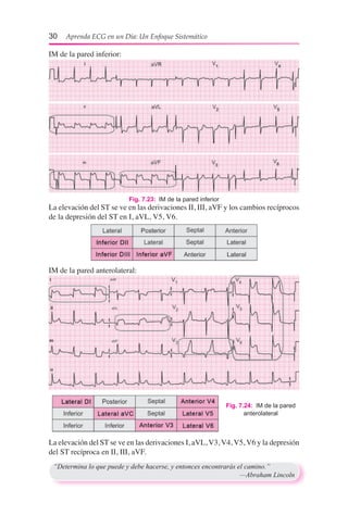 30  Aprenda ECG en un Día: Un Enfoque Sistemático
La elevación del ST se ve en las derivaciones II, III, aVF y los cambios recíprocos
de la depresión del ST en I, aVL, V5, V6.
IM de la pared anterolateral:
Fig. 7.23:  IM de la pared inferior
IM de la pared inferior:
Fig. 7.24:  IM de la pared
anterolateral
La elevación del ST se ve en las derivaciones I, aVL, V3, V4, V5, V6 y la depresión
del ST recíproca en II, III, aVF.
“Determina lo que puede y debe hacerse, y entonces encontrarás el camino.”	
	 —Abraham Lincoln
 