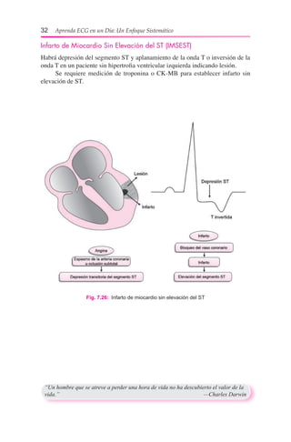 32  Aprenda ECG en un Día: Un Enfoque Sistemático
Infarto de Miocardio Sin Elevación del ST (IMSEST)
Habrá depresión del segmento ST y aplanamiento de la onda T o inversión de la
onda T en un paciente sin hipertrofia ventricular izquierda indicando lesión.
      Se requiere medición de troponina o CK-MB para establecer infarto sin
elevación de ST.
“Un hombre que se atreve a perder una hora de vida no ha descubierto el valor de la
vida.”	 —Charles Darwin
Fig. 7.26:  Infarto de miocardio sin elevación del ST
 