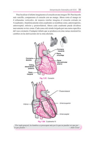 Interpretación Sistemática del ECG 33
	 Para localizar el infarto imaginemos el corazón en una imagen 3D. Para hacerlo
más sencillo, comparemos el corazón con un mango. Ahora corta el mango en	
4 rebanadas verticales, de manera similar imagina el corazón cortado en	
4 cuadrantes.Anatómicamente estos cuadrantes se nombran como, anterosuperior,
anteroseptal, inferior y posterolateral. Ahora cada cuadrante puede dividirse
nuevamente en tres zonas. Cada zona está siendo irrigada por una rama específica
del vaso coronario. Cualquier infarto que se produzca en estas ramas mostrará los
cambios en las derivaciones de la zona afectada.
Fig. 7.27:  Corazón
Fig. 7.28:  Cuadrante VI
“Por regla general, los hombres se preocupan más por lo que no pueden ver que por
lo que pueden.”	 —Julio César
 