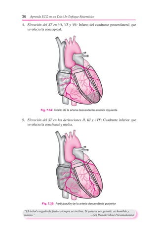 36  Aprenda ECG en un Día: Un Enfoque Sistemático
4.	 Elevación del ST en V4, V5 y V6: Infarto del cuadrante posterolateral que
involucra la zona apical.
5.	 Elevación del ST en las derivaciones II, III y aVF: Cuadrante inferior que
involucra la zona basal y media.
Fig. 7.34:  Infarto de la arteria descendente anterior izquierda
Fig. 7.35:  Participación de la arteria descendente posterior
“El árbol cargado de frutos siempre se inclina. Si quieres ser grande, se humilde y
manso.”	 —Sri Ramakrishna Paramahamsa
 