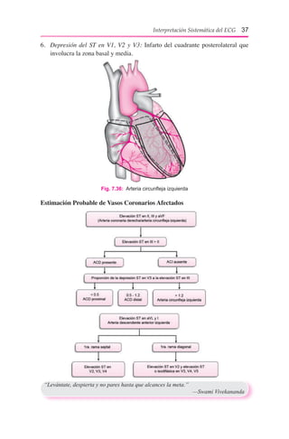 Interpretación Sistemática del ECG 37
6.	 Depresión del ST en V1, V2 y V3: Infarto del cuadrante posterolateral que
involucra la zona basal y media.
Fig. 7.36:  Arteria circunfleja izquierda
Estimación Probable de Vasos Coronarios Afectados
“Levántate, despierta y no pares hasta que alcances la meta.”
	 —Swami Vivekananda
 