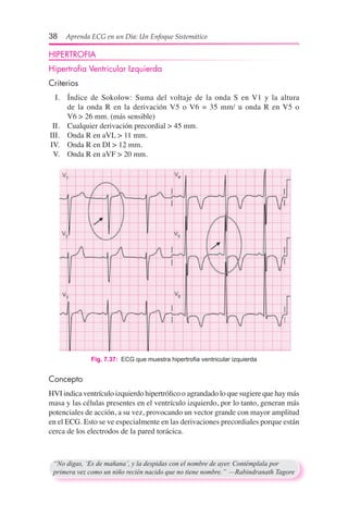 38  Aprenda ECG en un Día: Un Enfoque Sistemático
HIPERTROFIA
Hipertrofia Ventricular Izquierda
Criterios
	 I.	 Índice de Sokolow: Suma del voltaje de la onda S en V1 y la altura
de la onda R en la derivación V5 o V6 = 35 mm/ u onda R en V5 o	
V6 > 26 mm. (más sensible)
	 II.	 Cualquier derivación precordial > 45 mm.
	III.	 Onda R en aVL > 11 mm.
	IV.	 Onda R en DI > 12 mm.
	 V.	 Onda R en aVF > 20 mm.
Fig. 7.37:  ECG que muestra hipertrofia ventricular izquierda
Concepto
HVI indica ventrículo izquierdo hipertrófico o agrandado lo que sugiere que hay más
masa y las células presentes en el ventrículo izquierdo, por lo tanto, generan más
potenciales de acción, a su vez, provocando un vector grande con mayor amplitud
en el ECG. Esto se ve especialmente en las derivaciones precordiales porque están
cerca de los electrodos de la pared torácica.
“No digas, ‘Es de mañana’, y la despidas con el nombre de ayer. Contémplala por
primera vez como un niño recién nacido que no tiene nombre.”	—Rabindranath Tagore
 