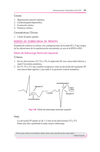 Interpretación Sistemática del ECG 39
Causas
1.	 Hipertensión arterial sistémica
2.	 Cardiomiopatía hipertrófica
3.	 Coartación aórtica
4.	 Estenosis aórtica.
Características Clínicas
1.	 Latido de punta agitado.
PATRÓN DE SOBRECARGA DE PRESION
El patrón de esfuerzo se refiere a las configuraciones de la onda ST y T que surgen
de las alteraciones de la repolarización encontradas ya sea en la HVD o HVI.
Patrón de Sobrecarga Ventricular Izquierdo
Criterios
1.	 En las derivaciones V4, V5 y V6, la depresión ST con concavidad inferior y
onda T invertida asimétrica.
2.	 En V1, V2 y V3, hay cambios recíprocos como la elevación del segmento ST
con concavidad superior y una onda T en posición vertical asimétrica.
Fig. 7.38:  Patrón de sobrecarga ventricular izquierdo
Nota
	 La elevación ST puede ser de 1-3 mm en las derivaciones V2 y V3.
	 Entre más alta o profunda la onda, mayor sobrecarga.
“Para tener éxito en tu misión, debes tener una sola devoción como meta.”	
	 —Abdul Kalam
 